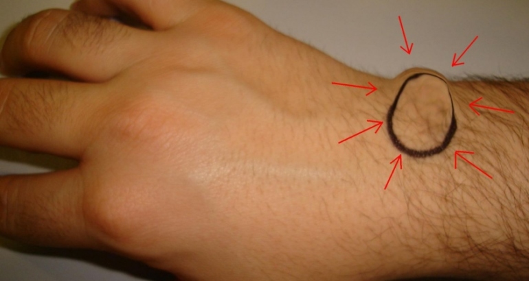Ganglion and Wrist Cysts