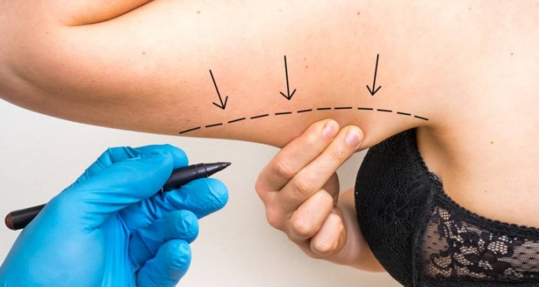 Arm Lift – Brachioplasty