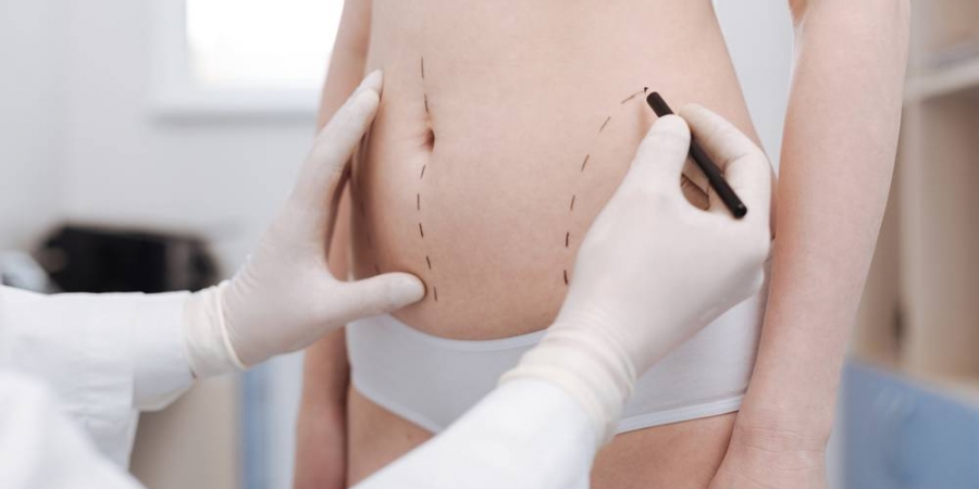 Liposuction