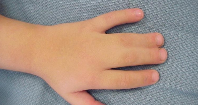 Webbed Fingers – Syndactyly
